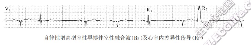 自律性增高型室性早搏伴室性融合波(R5)及心室内差异性传导(R7)（心电图）
