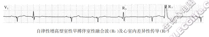 心室自律性增高型心律失常