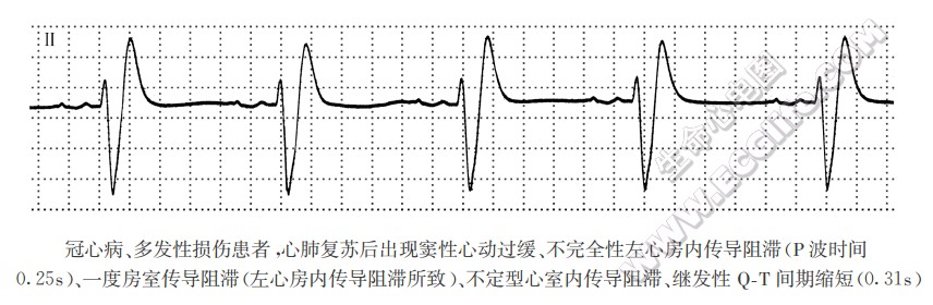 冠心病、多发性损伤患者；固定性左心房内传导阻滞（心电图）