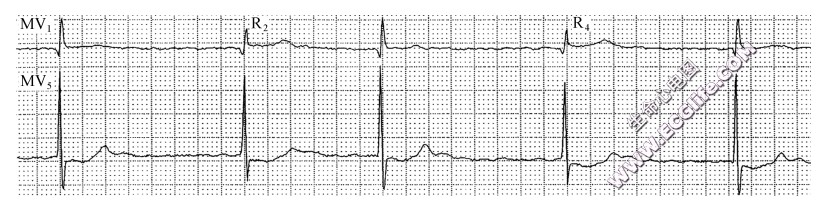 心房颤动时房室交接性逸搏的识别（心电图）