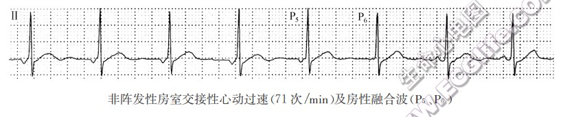 非阵发性房室交接性心动过速（心电图）