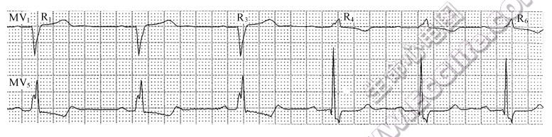 双束支阻滞的心电图表现