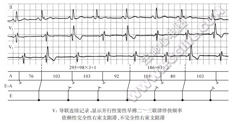 窦性并行心律心电图表现