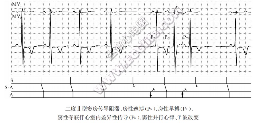 房性逸搏、房性早搏并存揭示窦性并行心律（心电图）