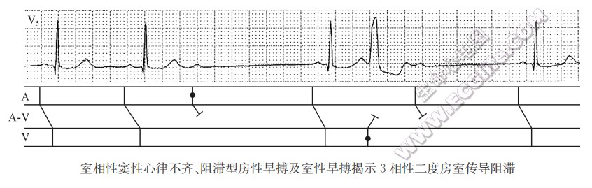 心律失常诊断——梯形图解