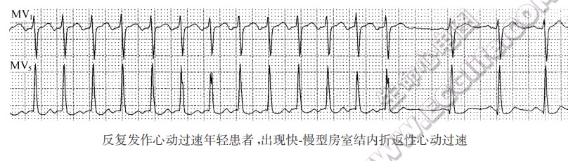 反复发作心动过速年轻患者，出现快．慢型房室结内折返性心动过速（心电图）