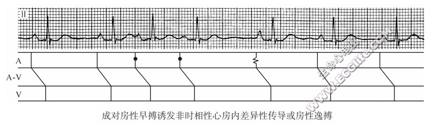 成对房性早搏诱发非时相性心房内差异性传导或房性逸搏（心电图）