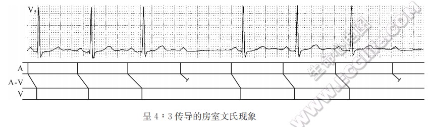 呈4:3传导的房室文氏现象（心电图）