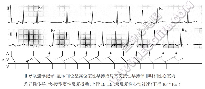 Ⅱ导联连续记录，显示间位型高位室性早搏或房室交接性早搏伴非时相性心室内差异性传导、快-慢型窦性反复搏动及反复性心动过速（心电图）