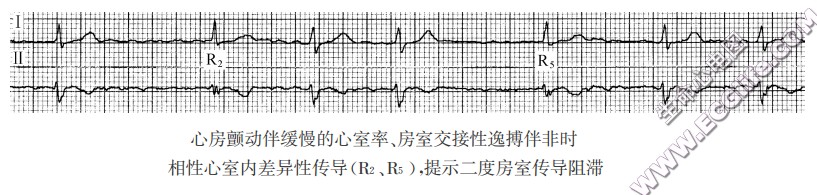 心房颤动伴缓慢的心室率、房室交接性逸搏伴非时相性心室内差异性传导(R2、R5)，提示二度房室传导阻滞