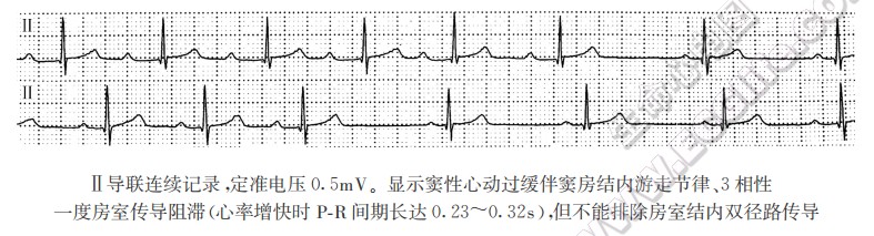 3相性一度房窒传导阻滞