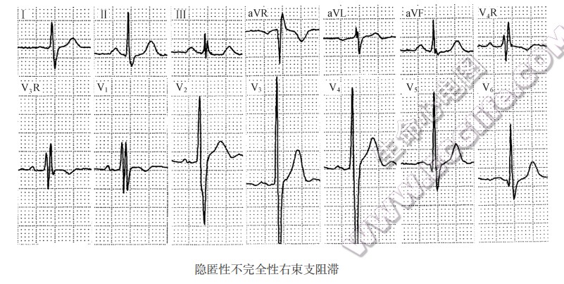 隐匿性不完全性右柬支阻滞（心电图）