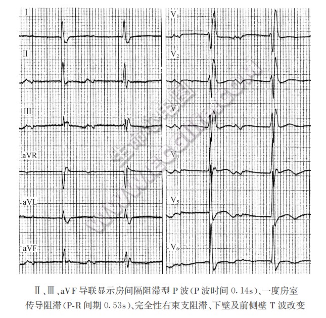 房间隔传导阻滞（心电图）