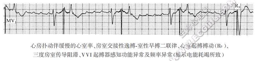 三度房室传导阻滞（心电图）