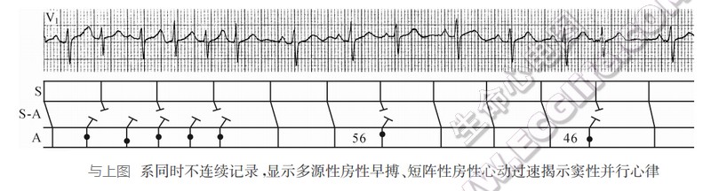 短阵性房性心动过速揭示窦性并行心律（心电图）