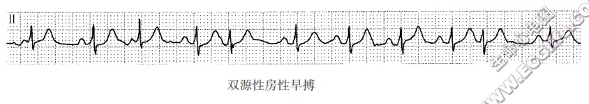 双源性房性早搏（心电图）