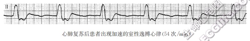 心肺复苏后患者m现加速的室性逸搏心律（心电图）