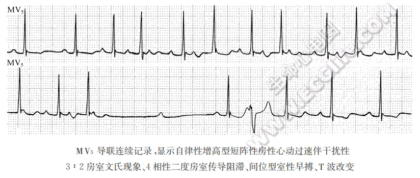 3相合并4相性房室传导阻滞（心电图）