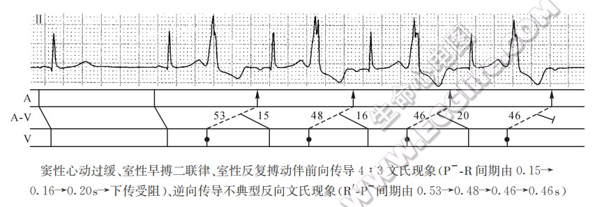 窦性心动过缓、室性早搏二联律、室性反复搏动伴前向传导4:3文氏现象（心电图）