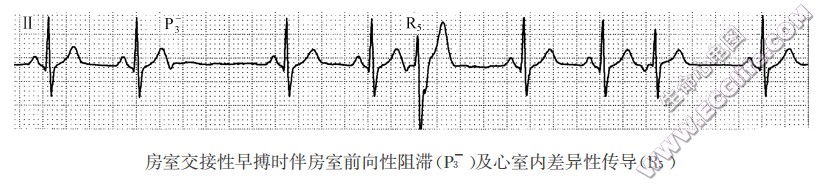 房室交接性早搏伴心室内差异性传导（心电图）