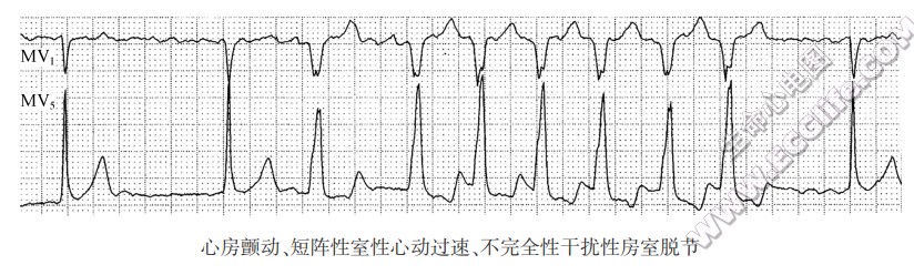 心房颤动、短阵性室性心动过速、不完全性干扰性房室脱节（心电图）