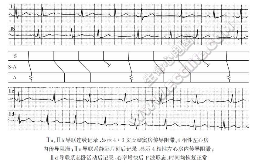 慢频率依赖性左心房内传导阻滞（心电图）