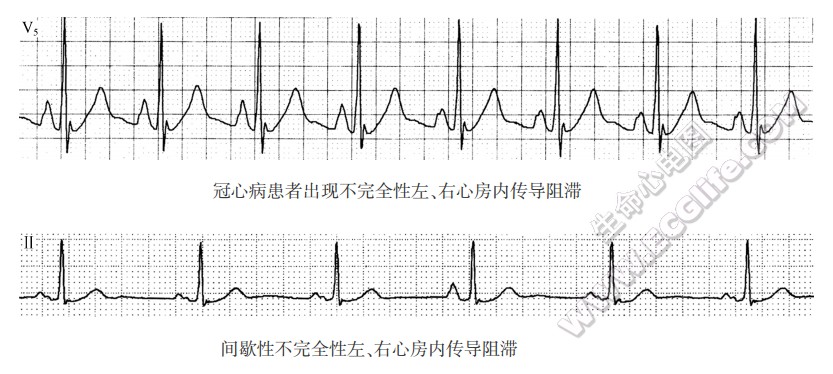 间歇性不完全性左、右心房内传导阻滞（心电图）