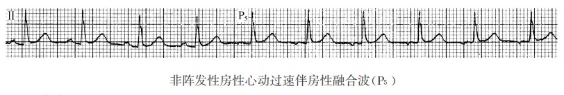 非阵发性房性心动过速伴房性融合波（心电图）