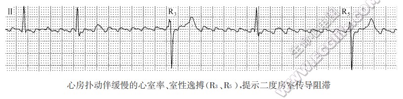 心房扑动伴缓慢的心室率、室性逸搏(R3、R5)，提示二度房室传导阻滞