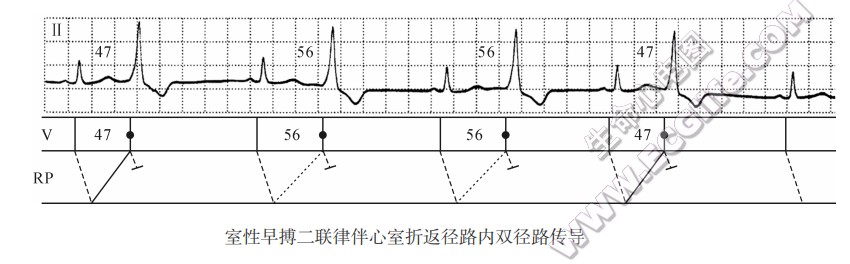 室性早搏二联律伴心室折返径路内双径路传导（心电图）