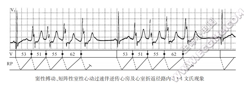 窦性搏动、短阵性室性心动过速伴逆传心房及心室折返径路内5：4文氏现象（心电图）