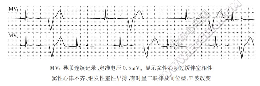 继发性室性早搏（心电图）