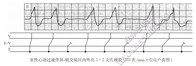 室性心动过速伴异-肌交接区内外出3：2文氏现象（心电图，引自户喜烈）