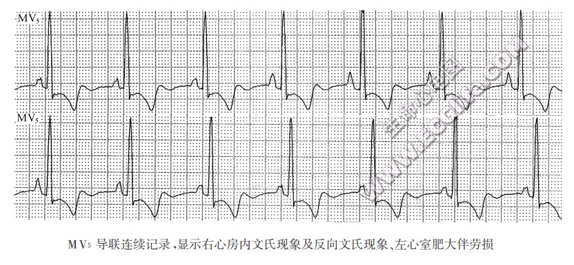 不完全性心房内传导阻滞