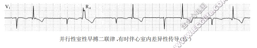 并行性室性早搏二联律，有时伴心室内差异性传导(R4)