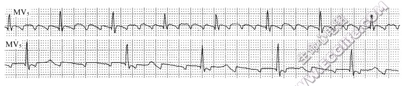 心房扑动伴外出阻滞（心电图）