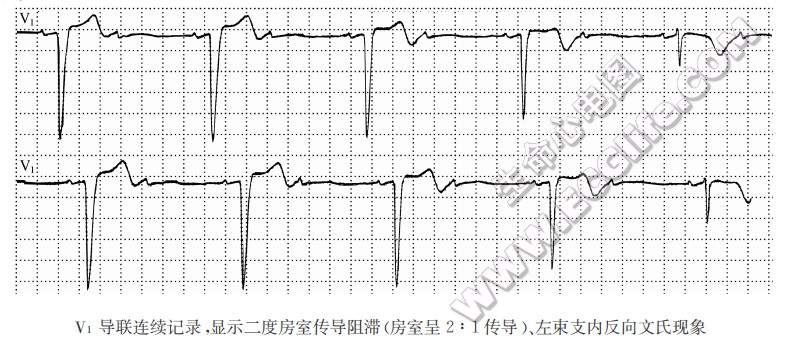 V1导联连续记录，显示二度房室传导阻滞（房室呈2：1传导）、左束支内反向文氏现象（心电图）