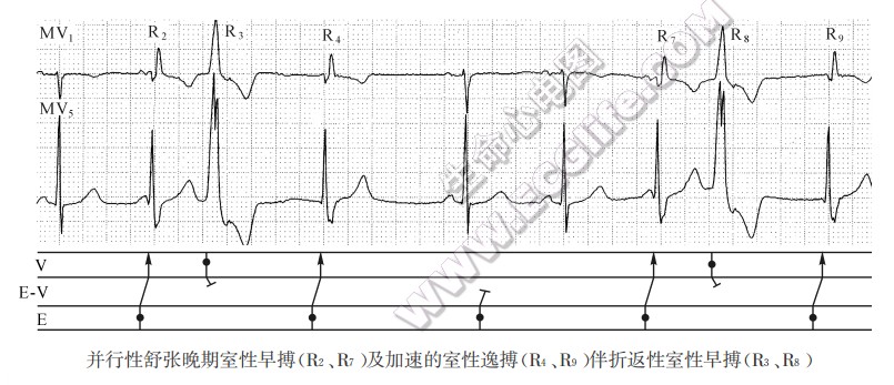 并行性舒张晚期室性早搏及加速的室性逸搏伴折返性室性早搏（心电图）