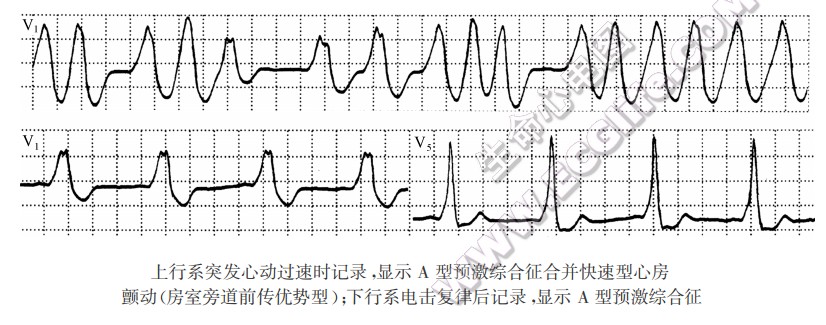 上行系突发心动过速时记录，显示A型预激综合征合并快速型心房颤动（房室旁道前传优势型）；下行系电击复律后记录，显示A型预激综合征（心电图）