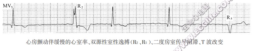 心房颤动伴缓慢的心室率、双源性室性逸搏(R2、R5)、二度房室传导阻滞、T波改变(心电图)