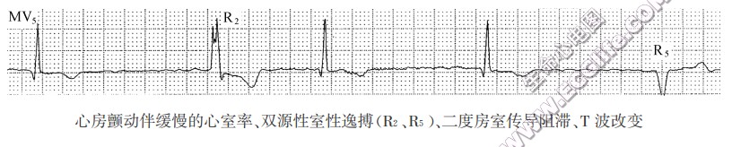 经典的心房颤动及其进展详解