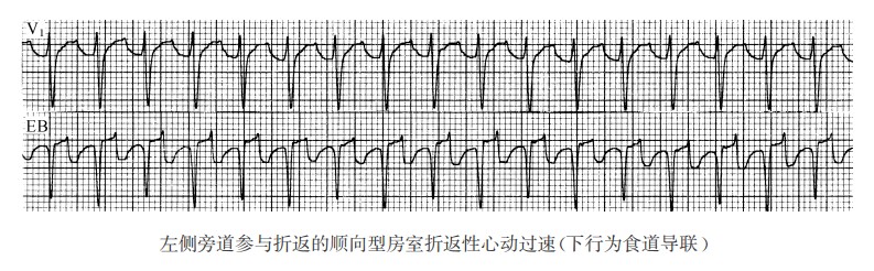 左侧旁道参与折返的顺向型房室折返性心动过速（下行为食道导联）（心电图）