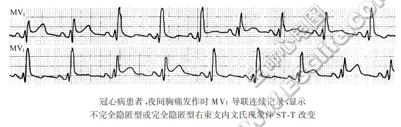不完全隐匿型或完全隐匿型右束支内文氏现象伴ST-T改变（心电图）