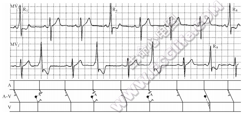 房室旁道性并行心律的心电图表现（心电图）