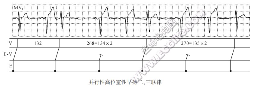 并行性高位室性早搏二、三联律（心电图）