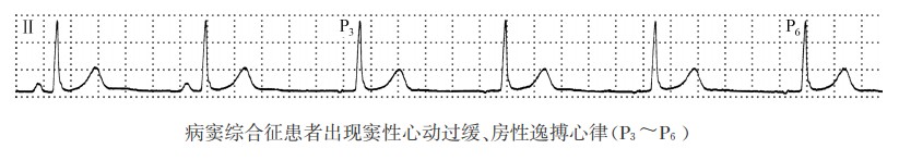 病窦综合征患者出现窦性心动过缓、房性逸搏心律（心电图）