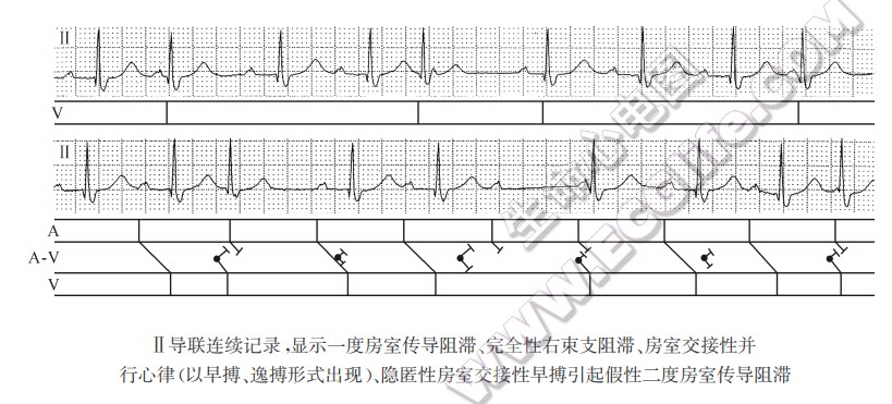 Ⅱ导联连续记录，显示一度房室传导阻滞、完全性右柬支阻滞、房室交接性并行心律（以早搏、逸搏形式出现）、隐匿性房室交接性早搏引起假性二度房室传导阻滞（心电图）