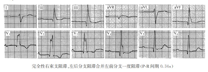 完全陛右柬支阻滞、左后分支阻滞合并左前分支一度阻滞（心电图）