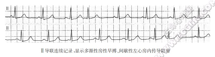 Ⅱ导联连续记录，显示多源性房性早搏、间歇性左心房内传导阻滞（心电图）