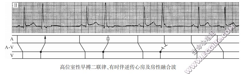 高位室性早搏二联律、有时伴逆传心房及房性融合波（心电图）